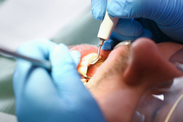 Best Emergency Dental Care for Broken or Chipped Teeth in Palmyra, NJ