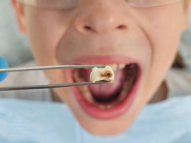 Best Emergency Tooth Extraction in Palmyra, NJ